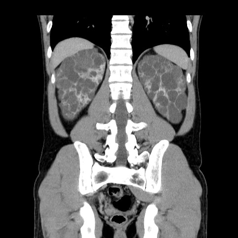 File:Autosomal dominant polycystic kidney disease (Radiopaedia 66349-75582 A 67).jpg
