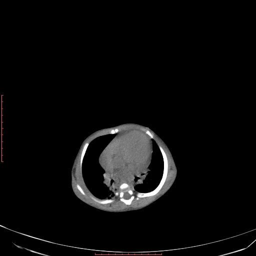 Autosomal recessive polycystic kidney disease associated with Caroli disease (Radiopaedia 61932-69984 B 61).jpg