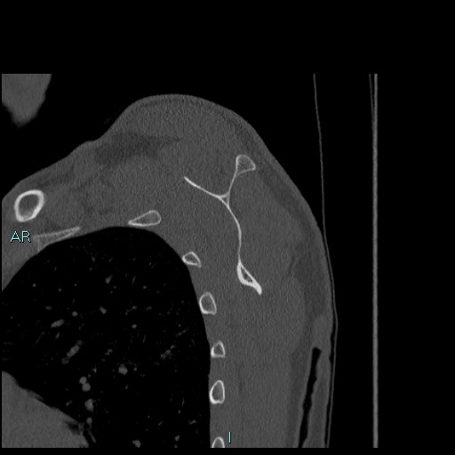 Avascular necrosis after fracture dislocations of the proximal humerus (Radiopaedia 88078-104655 Sagittal bone window 53).jpg