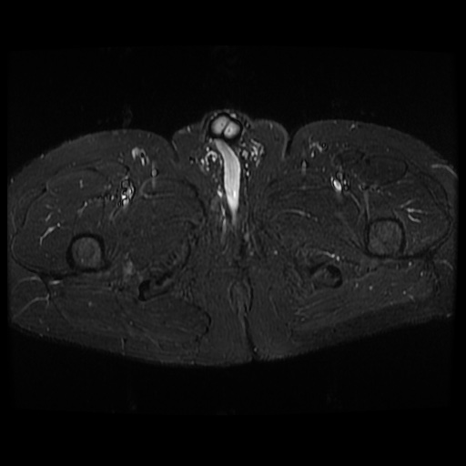 File:Avascular necrosis of the hip (Radiopaedia 61503-69465 Axial STIR 29).jpg
