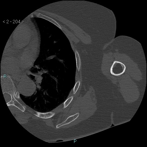 Avascular necrosis of the shoulder - Cruess stage I (Radiopaedia 77674-89887 Axial bone window 51).jpg