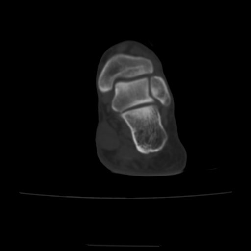 Avulsion fracture of the dorsal cuboid bone (Radiopaedia 51586-57377 Axial bone window 18).jpg