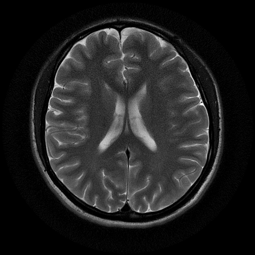File:Azygos anterior cerebral artery (Radiopaedia 17059-16756 Axial T2 10).jpg