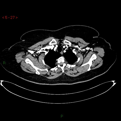 Azygos fissure and lobe (Radiopaedia 47620-52278 A 13).jpg