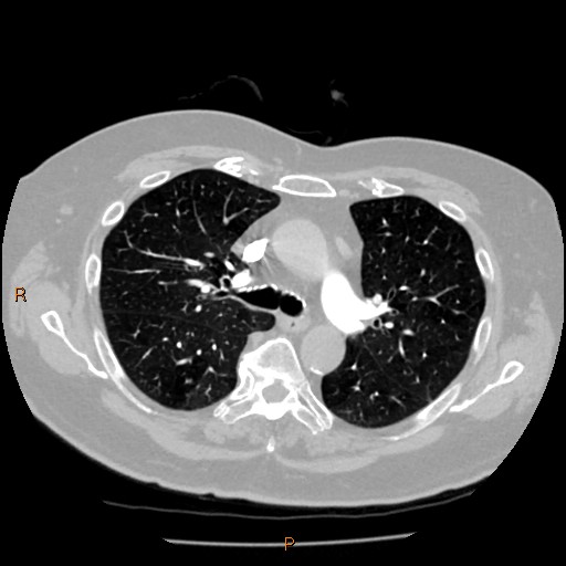 Azygos lobe (Radiopaedia 40161-42821 Axial lung window 25).jpg