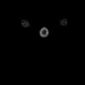 B-cell lymphoma of the mesentery (Radiopaedia 65743-74868 18F-FDG PET-CT 317).jpg