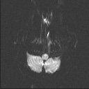 Balo concentric sclerosis (Radiopaedia 50458-55940 Axial DWI 43).jpg