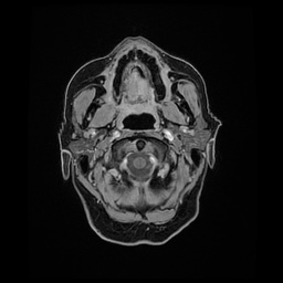 Balo concentric sclerosis (Radiopaedia 53875-59982 Axial LAVA C+ 18).jpg
