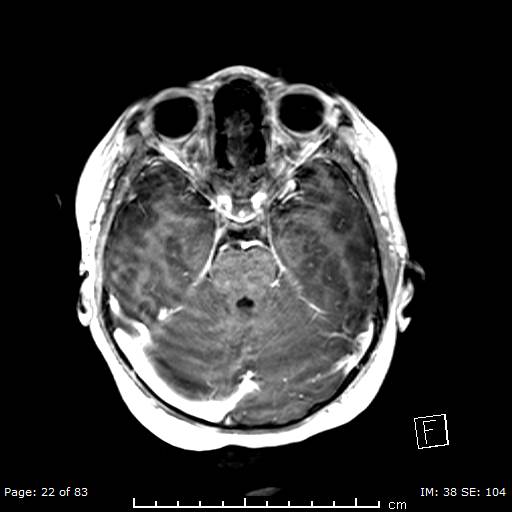 Balo concentric sclerosis (Radiopaedia 61637-69636 Axial T1 C+ 22).jpg