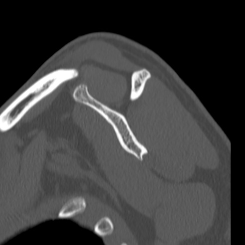 Bankart lesion (Radiopaedia 57256-64185 Sagittal bone window 37).jpg