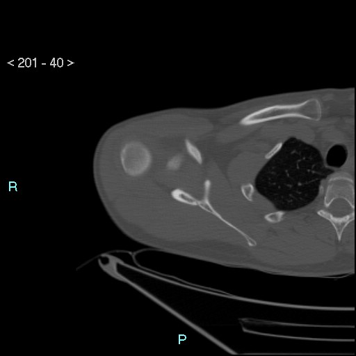 Bankart lesion with glenoid bone defect - assessment TC with PICO method (Radiopaedia 42855-93901 Axial bone window 39).jpg