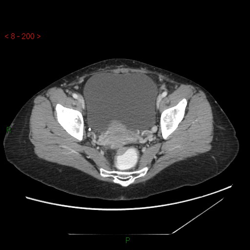 Bartholin gland cyst (Radiopaedia 54904-61181 A 50).jpg