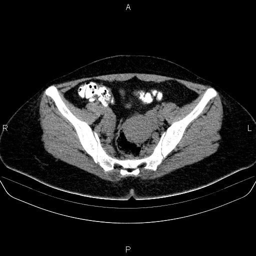 Bartholin gland cyst (Radiopaedia 62635-70930 Axial non-contrast 36).jpg