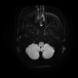 File:Basal cell carcinoma (periorbital) (Radiopaedia 55179-61559 Axial DWI 4).jpg