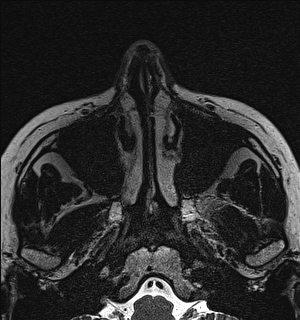 Basal cell carcinoma - nasal region (Radiopaedia 70292-80365 Axial Gradient Echo 12).jpg