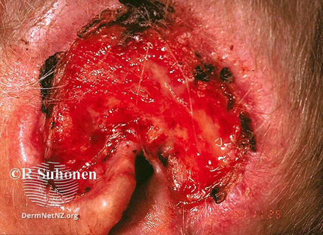 File:Basal cell carcinoma affecting the ear (DermNet NZ lesions-bcc-ear-0645).jpg