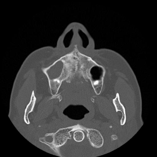 File:Base of skull chondrosarcoma (Radiopaedia 30410-31071 Axial bone window 5).jpg