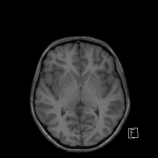 Base of skull rhabdomyosarcoma (Radiopaedia 32196-33142 Axial T1 27).jpg