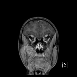Base of skull rhabdomyosarcoma (Radiopaedia 32196-33142 I 23).jpg