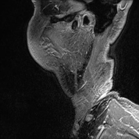 Base of tongue squamous cell carcinoma (Radiopaedia 31174-31884 F 164).jpg