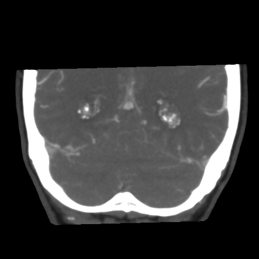 File:Basilar artery fenestration and aneurysms with subarachnoid hemorrhage (Radiopaedia 40066-42573 B 43).png