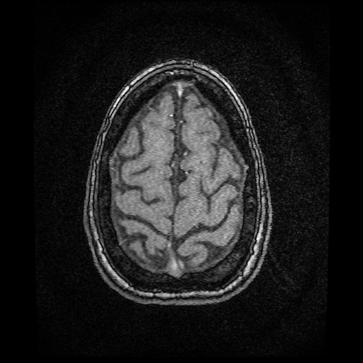 Basilar top and left middle cerebral artery aneurysm (Radiopaedia 61965-70031 Axial MRA 153).jpg