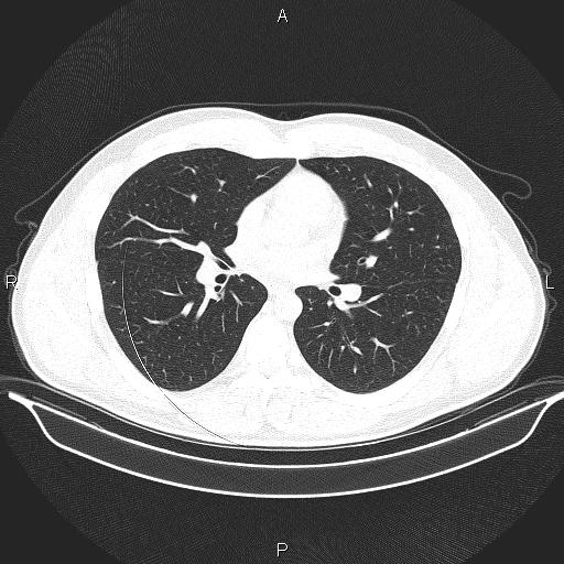 Beam hardening and ring artifacts (Radiopaedia 85323-100915 Axial lung window 40).jpg