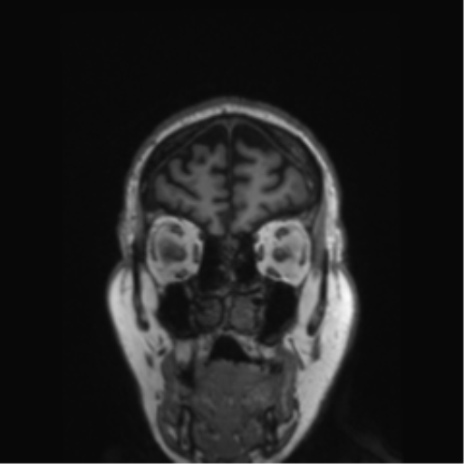 Behavioral variant frontotemporal dementia and late onset schizophrenia (Radiopaedia 52197-58083 Coronal T1 78).png