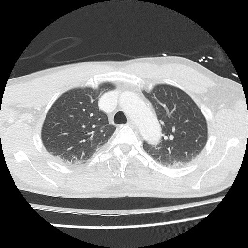 Benign post-traumatic pseudopneumoperitoneum (Radiopaedia 71199-81495 Axial lung window 26).jpg