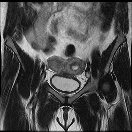File:Bicornuate uterus (Radiopaedia 51676-57472 Coronal T2 9).jpg