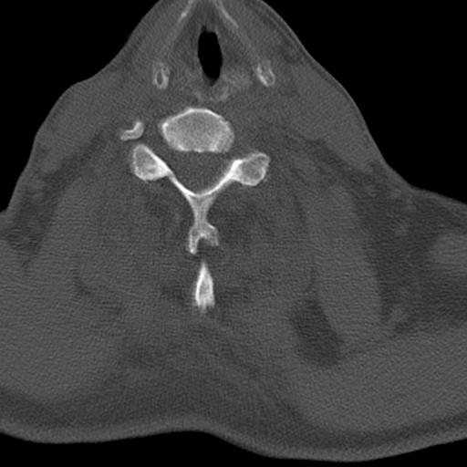 File:Bilateral C6-7 locked facet dislocation (Radiopaedia 28506-28748 Axial bone window 19).jpeg