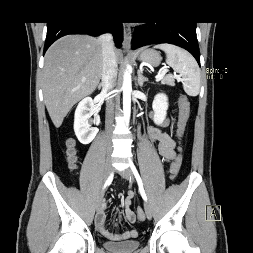 File:Bilateral accessory renal arteries with mild pelvi-ureteric junction (PUJ) obstruction (Radiopaedia 66357-75596 B 21).jpg
