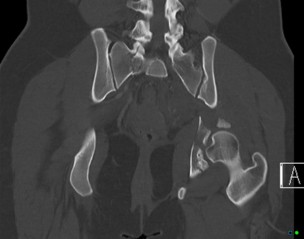 File:Bilateral acetabular fractures (Radiopaedia 79272-92308 Coronal bone window 28).jpg