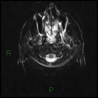 File:Bilateral acute middle cerebral artery territory infarcts (Radiopaedia 77319-89402 Axial DWI 2).jpg