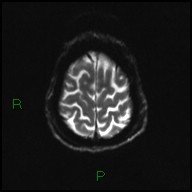 File:Bilateral acute middle cerebral artery territory infarcts (Radiopaedia 77319-89402 Axial DWI 21).jpg