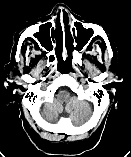 Bilateral acute on chronic subdural hematomas (Radiopaedia 78466-91146 Axial non-contrast 13).jpg