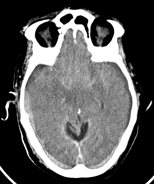 Bilateral acute on chronic subdural hematomas (Radiopaedia 78466-91146 Axial non-contrast 25).jpg