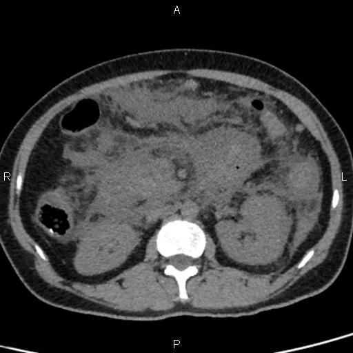 Bilateral adrenal gland hyperenhancement in pancreatitis (Radiopaedia 86642-102753 Axial non-contrast 49).jpg