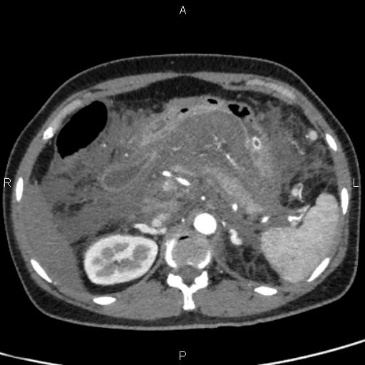 File:Bilateral adrenal gland hyperenhancement in pancreatitis (Radiopaedia 86642-102753 B 39).jpg