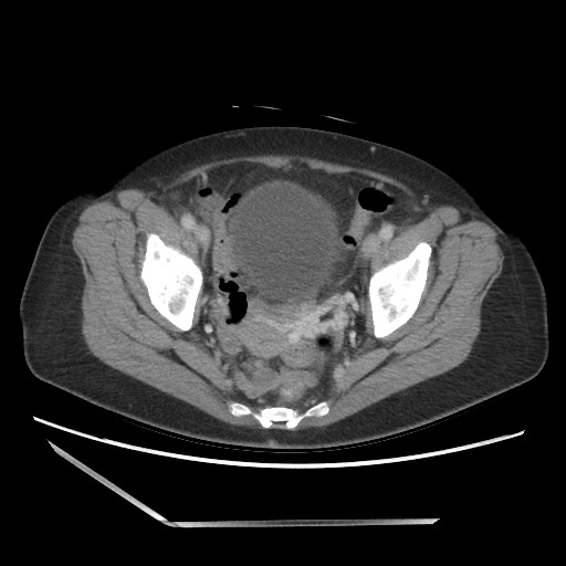 Bilateral adrenal granulocytic sarcomas (chloromas) (Radiopaedia 78375-91007 A 103).jpg