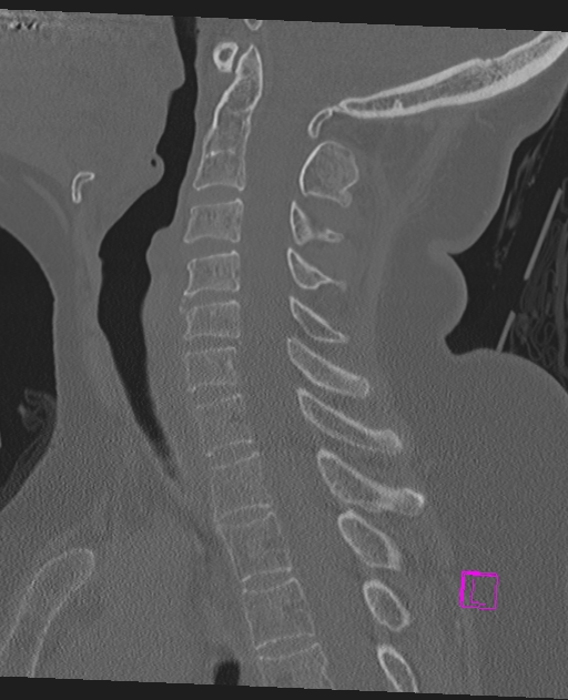 Bilateral atlanto-occipital assimilation (Radiopaedia 28350-28603 Sagittal bone window 40).jpg