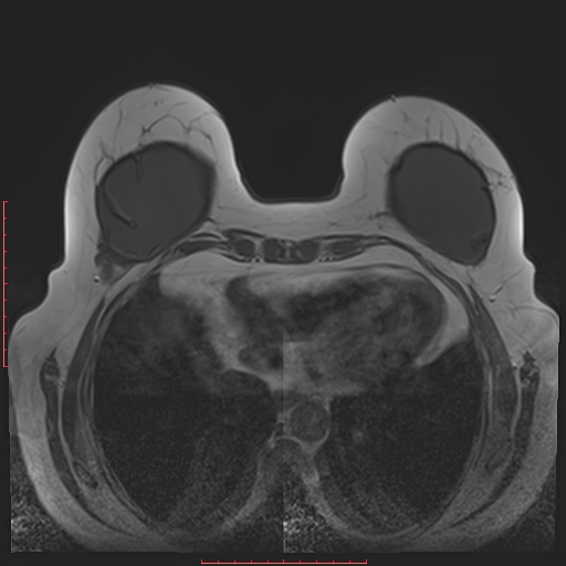File:Bilateral breast implant rupture (Radiopaedia 24761-25027 T1 27).jpg