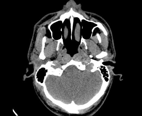 Bilateral carotid body tumors (Radiopaedia 61841-69870 Axial non-contrast 8).jpg