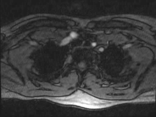Bilateral carotid body tumors and right glomus jugulare tumor (Radiopaedia 20024-20060 Axial MRA 178).jpg