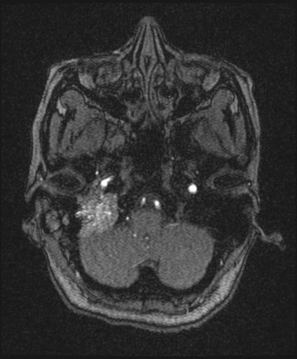 Bilateral carotid body tumors and right glomus jugulare tumor (Radiopaedia 20024-20060 Axial MRA 29).jpg