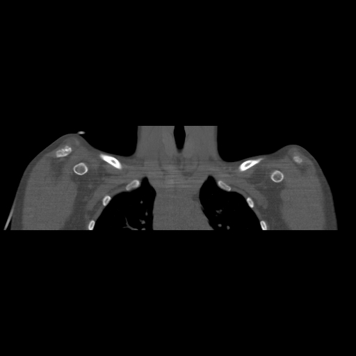 Bilateral chronic posterior shoulder dislocation (Radiopaedia 39213-41452 Coronal bone window 15).jpg