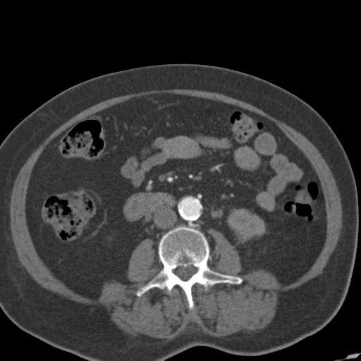 File:Bilateral delayed nephrogram from renal artery stenosis (Radiopaedia 47681-52362 A 31).png