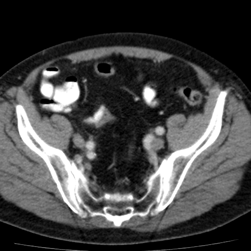 File:Bilateral direct inguinal herniae (Radiopaedia 17016-16719 B 4).jpg