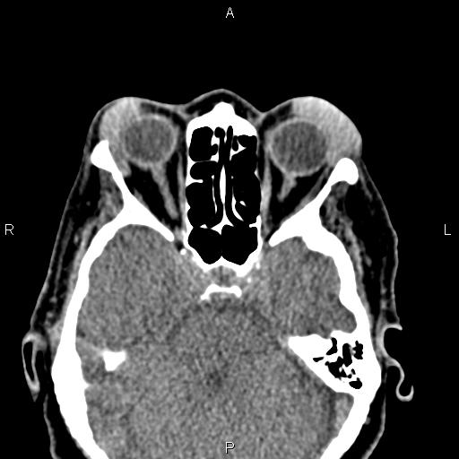 Bilateral enlargement of lacrimal glands - sarcoidosis (Radiopaedia 62627-70921 Axial non-contrast 46).jpg