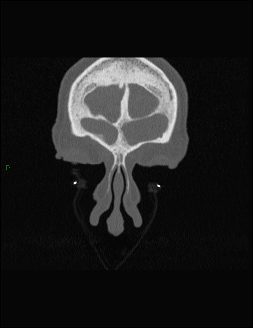 Bilateral frontal mucoceles (Radiopaedia 82352-96454 Coronal 52).jpg